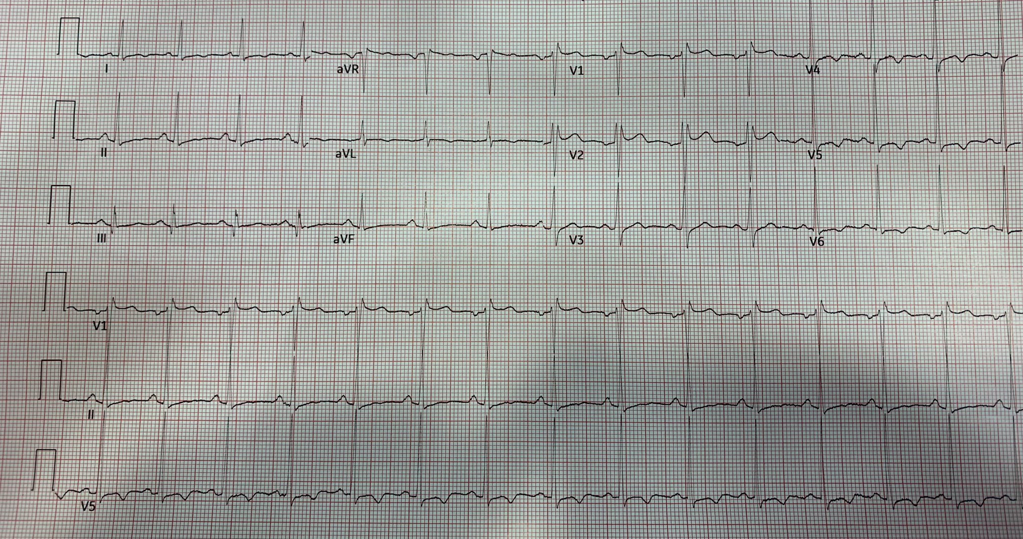 master-the-ecg-on-twitter-40s-asian-man-pmh-of-htn-attends-the-ed