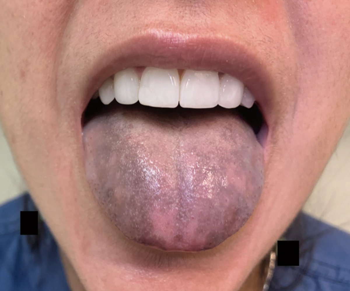 Everardox2's tweet photo. 💡In primary adrenal insufficiency, skin hyperpigmentation is often generalized and involves sun-exposed areas, the palmar creases, nail beds, and mucous membranes; isolated tongue discoloration is less common.

🔗DOI: 10.1056/NEJMicm2100706 @NEJM
#EndoTips https://t.co/IVDMgxmOgz