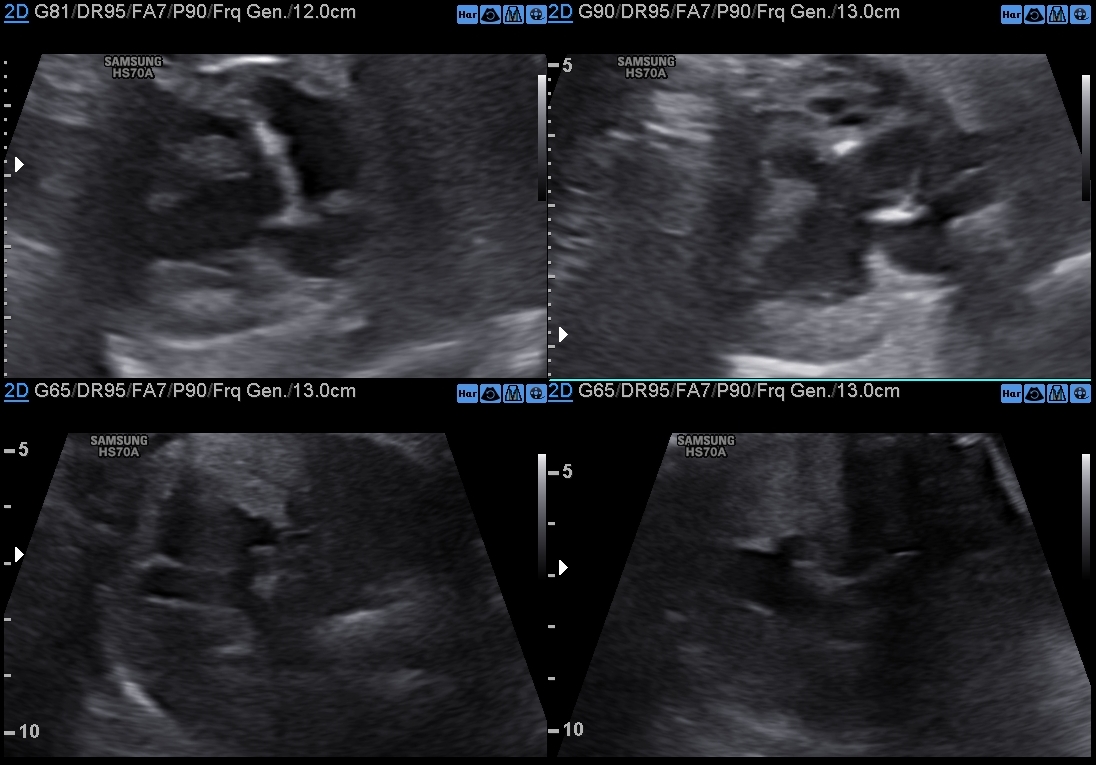ShiviRadiology's tweet photo. Patient came to us for the first time at 35wk gestaion for US-FWB. 
Diagnosis: Tricuspid Atresia with VSD
@DrAyushGoel #FetalEcho #FetalEchocardiography
https://t.co/RLq0fHZF5c
The eyes see only what the mind knows https://t.co/soj30mSCS7
