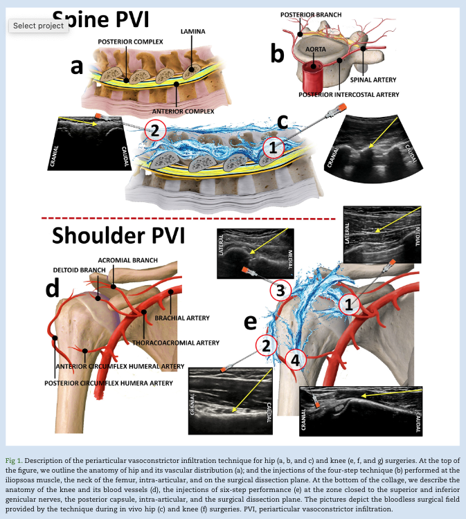 BJAJournals's tweet photo. Periarticular Vasoconstrictor Infiltration(PVI) technique: not just a bloodless field but potential analgesic effects in major orthopaedic surgery. New letter by Escolar et al.

#regionalanaesthesia #haemostasis #orthopaedicsurgery 

https://t.co/mVoHQlRSdk https://t.co/iMgjKkZaga