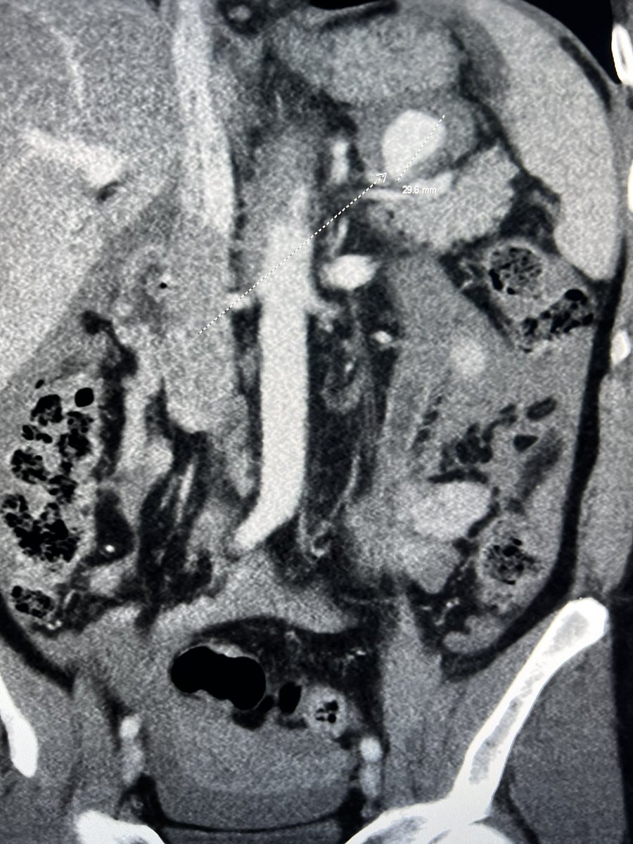 DonGarbettMD's tweet photo. 30ish yr old in ICU with bleeding splenic artery aneurysm and occluded celiac artery. Quick treatment and home next day. #aptus @PenVascular @ReNewVascular @_backtable @SDhandMD @SIRRFS @SIRspecialists https://t.co/ImARFZCK5W