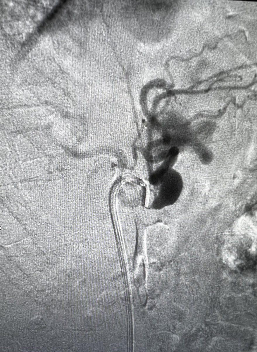 DonGarbettMD's tweet photo. 30ish yr old in ICU with bleeding splenic artery aneurysm and occluded celiac artery. Quick treatment and home next day. #aptus @PenVascular @ReNewVascular @_backtable @SDhandMD @SIRRFS @SIRspecialists https://t.co/ImARFZCK5W