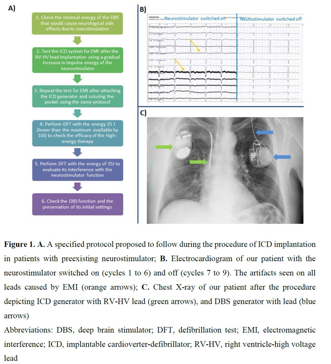 Polish Heart Journal (@heart_polish) on Twitter photo Editors' Insights: Simultaneous use of #ICD in patient with a preexisting deep #brain #stimulator - a proposed protocol of implantation.
bit.ly/3ASK7UK #KardiologiaPolska #PolishHeartJournal
#HeartNews @Aleksan47512389 <a href="/M_Lesiak/">Maciej Lesiak</a> <a href="/PUMS_tweets/">Poznan University of Medical Sciences</a> Editors' Insights: Simultaneous use of #ICD in patient with a preexisting deep #brain #stimulator - a proposed protocol of implantation.
bit.ly/3ASK7UK #KardiologiaPolska #PolishHeartJournal
#HeartNews @Aleksan47512389 <a href="/M_Lesiak/">Maciej Lesiak</a> <a href="/PUMS_tweets/">Poznan University of Medical Sciences</a>