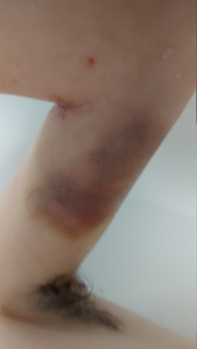 RobertrathierRR's tweet photo. Bonjour a tous ca fait Trés longtemps que je n'est pas tweeté,on parle de la violence sur des aînés malheureusement aussi sur les jeunes aldutes dans les Chsld mon fils a été pincé le bras j'ai intention de faire médiatisé car ils est temps que la violence arrête. https://t.co/DQBgCPNlAg