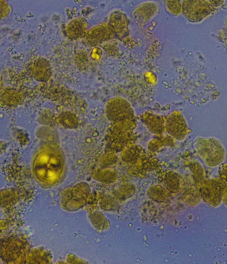 NAPI Channel ; jk, it’s a co-transporter (@therealleadapp) on Twitter photo Patient with pancreatic mass and biliary obstruction. Elevated T.Bili of 25. Developed AKI with urine sediment below with leucine crystals. #spinurine #weekendvibes <a href="/OchsnerNephro/">Ochsner Nephrology</a> <a href="/SwethaKanduriMD/">Swetha Kanduri</a> @anaisabelstark <a href="/VelezNephHepato/">Juan Carlos Q Velez</a> Patient with pancreatic mass and biliary obstruction. Elevated T.Bili of 25. Developed AKI with urine sediment below with leucine crystals. #spinurine #weekendvibes <a href="/OchsnerNephro/">Ochsner Nephrology</a> <a href="/SwethaKanduriMD/">Swetha Kanduri</a> @anaisabelstark <a href="/VelezNephHepato/">Juan Carlos Q Velez</a>