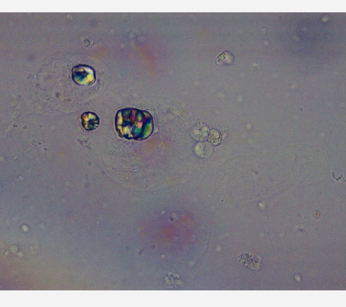 NAPI Channel ; jk, it’s a co-transporter (@therealleadapp) on Twitter photo Calcium oxalate monohydrate crystals. Going to try and make a necklace with them and sell as diamonds. <a href="/OchsnerNephro/">Ochsner Nephrology</a> <a href="/VelezNephHepato/">Juan Carlos Q Velez</a> @anaisabelstark<a href="/SwethaKanduriMD/">Swetha Kanduri</a> #urinemicroscopy Calcium oxalate monohydrate crystals. Going to try and make a necklace with them and sell as diamonds. <a href="/OchsnerNephro/">Ochsner Nephrology</a> <a href="/VelezNephHepato/">Juan Carlos Q Velez</a> @anaisabelstark<a href="/SwethaKanduriMD/">Swetha Kanduri</a> #urinemicroscopy