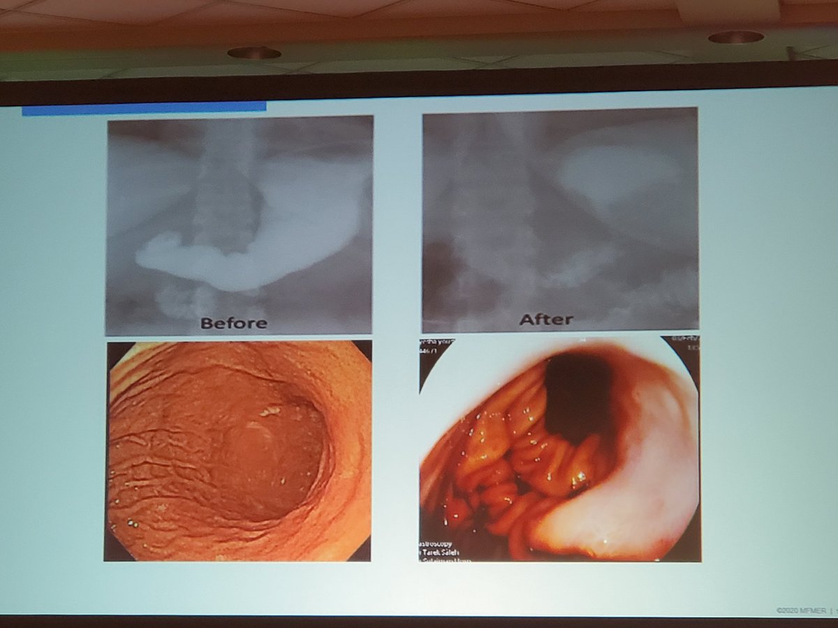 IBD_Afzali's tweet photo. Future of Gastroenterology is here - Endobariatrics - wow! presented by Dr Barham Abu Dayyeh @MayoClinicGIHep @AmCollegeGastro #ACGRegionals https://t.co/1HoUhVWFaR