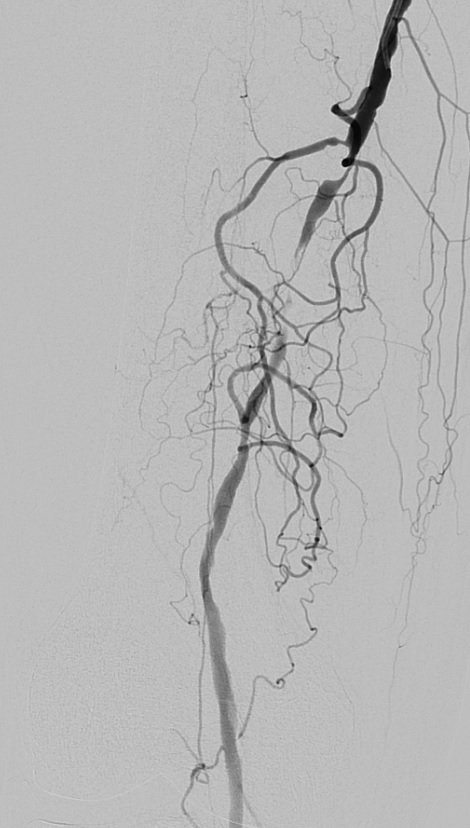drjunjieng's tweet photo. 80/M with acute on chronic limb ischaemia treated with Rotarex thrombectomy, Ultrascore focused PTA balloon and Lutonix DCB. Beautiful results with good lumen regain and no dissection. #vascular #CLTI #CLTIfighters #rotarex https://t.co/cEB3Bgi1RR