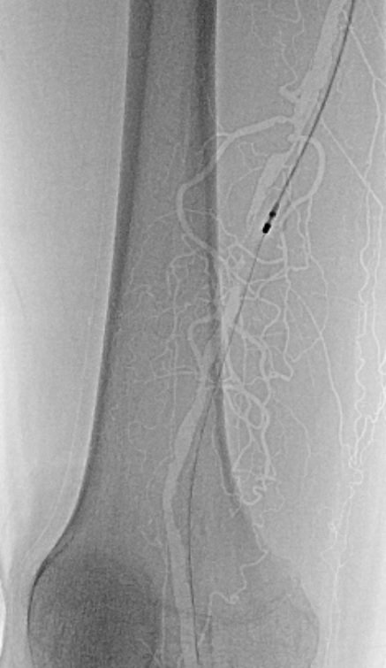 drjunjieng's tweet photo. 80/M with acute on chronic limb ischaemia treated with Rotarex thrombectomy, Ultrascore focused PTA balloon and Lutonix DCB. Beautiful results with good lumen regain and no dissection. #vascular #CLTI #CLTIfighters #rotarex https://t.co/cEB3Bgi1RR
