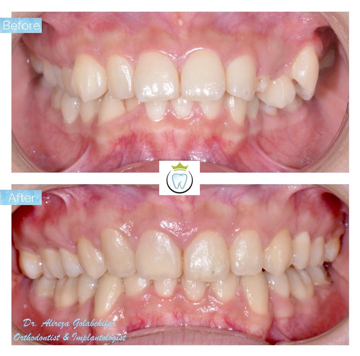 dentistry_king's tweet photo. Check out this Transformation!
This young patient came to us with excessive crowding and ectopic eruption #23. With help of braces we were able to relieve the crowding and bring #23 to the correct position. 
 
#orthodontics #braces #smile #smiletransformation #cosmeticdentistry https://t.co/O16PsrQ5jT