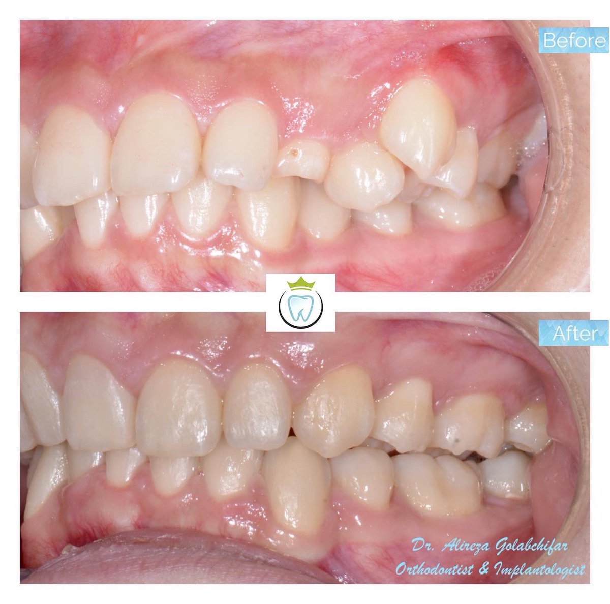 dentistry_king's tweet photo. Check out this Transformation!
This young patient came to us with excessive crowding and ectopic eruption #23. With help of braces we were able to relieve the crowding and bring #23 to the correct position. 
 
#orthodontics #braces #smile #smiletransformation #cosmeticdentistry https://t.co/O16PsrQ5jT
