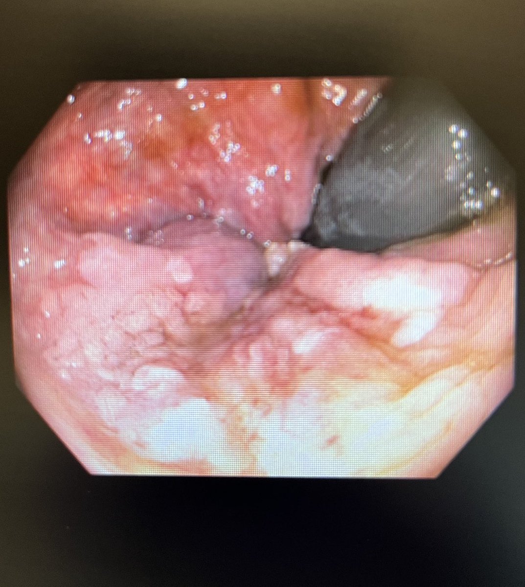 AnyQuezadaMD's tweet photo. Rectal / Anal warts in a 72y old men https://t.co/OifjrUcWYX