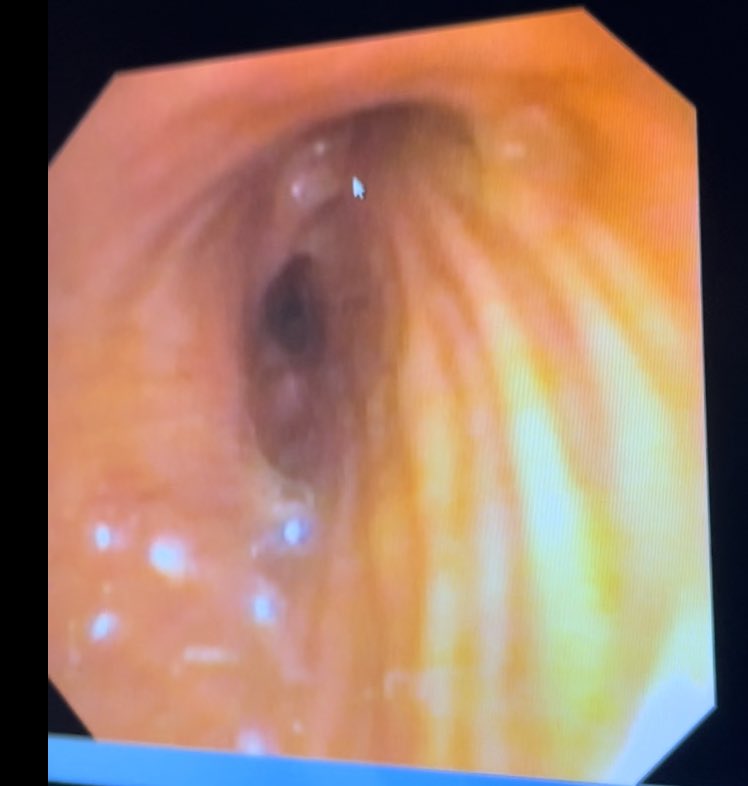 AnyQuezadaMD's tweet photo. Obstructive cholangiocarcinoma with biliary bronchial fistula. Bronchoscopy: trachea and bronchi covered with bile https://t.co/PBwb7msLkN