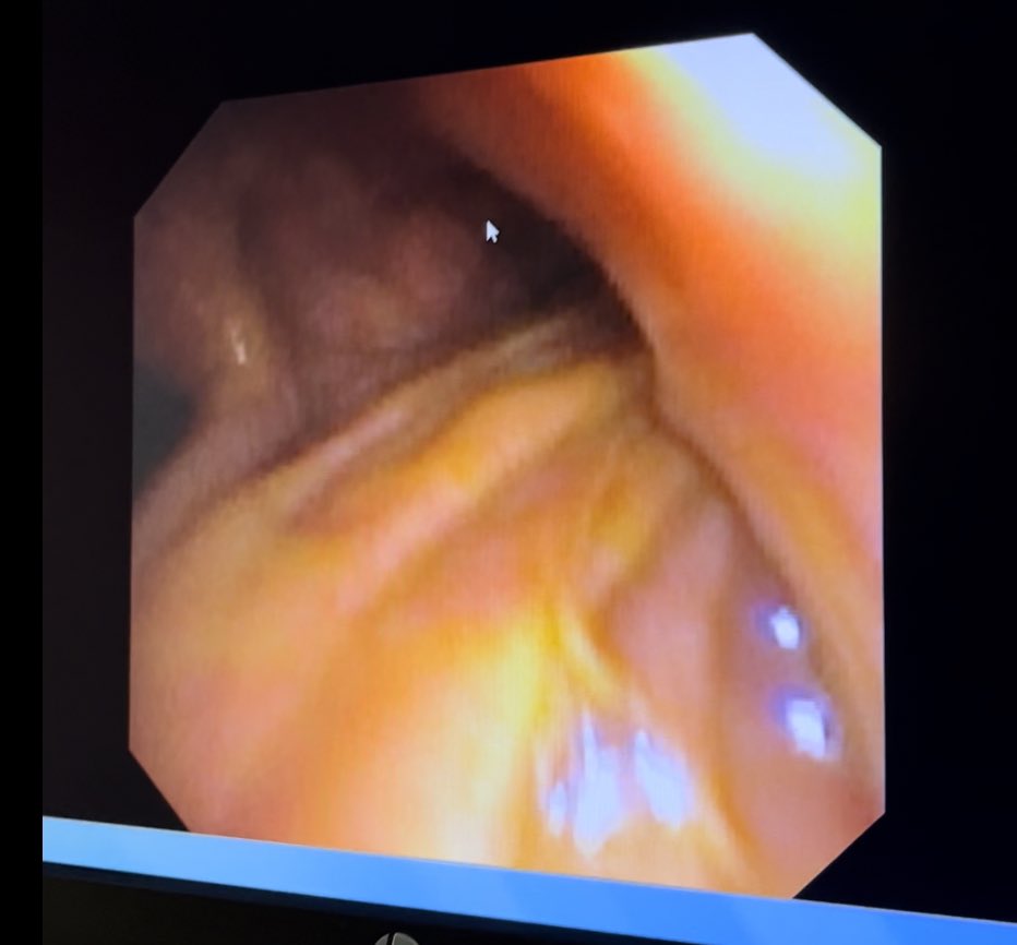 AnyQuezadaMD's tweet photo. Obstructive cholangiocarcinoma with biliary bronchial fistula. Bronchoscopy: trachea and bronchi covered with bile https://t.co/PBwb7msLkN