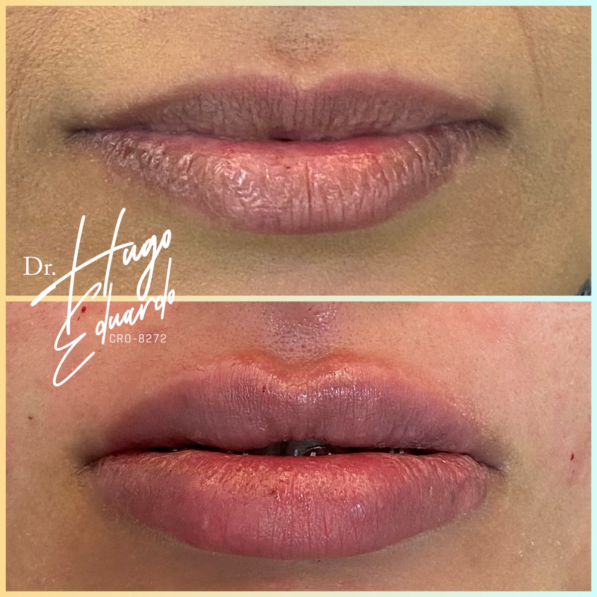 _hgeduardo's tweet image. Hoje fiz um curso vip de harmonização é meu Deus, tô apaixonado pelo meu trabalho e que bocas que eu fiz #PreenchimentoLabial ❤️😍