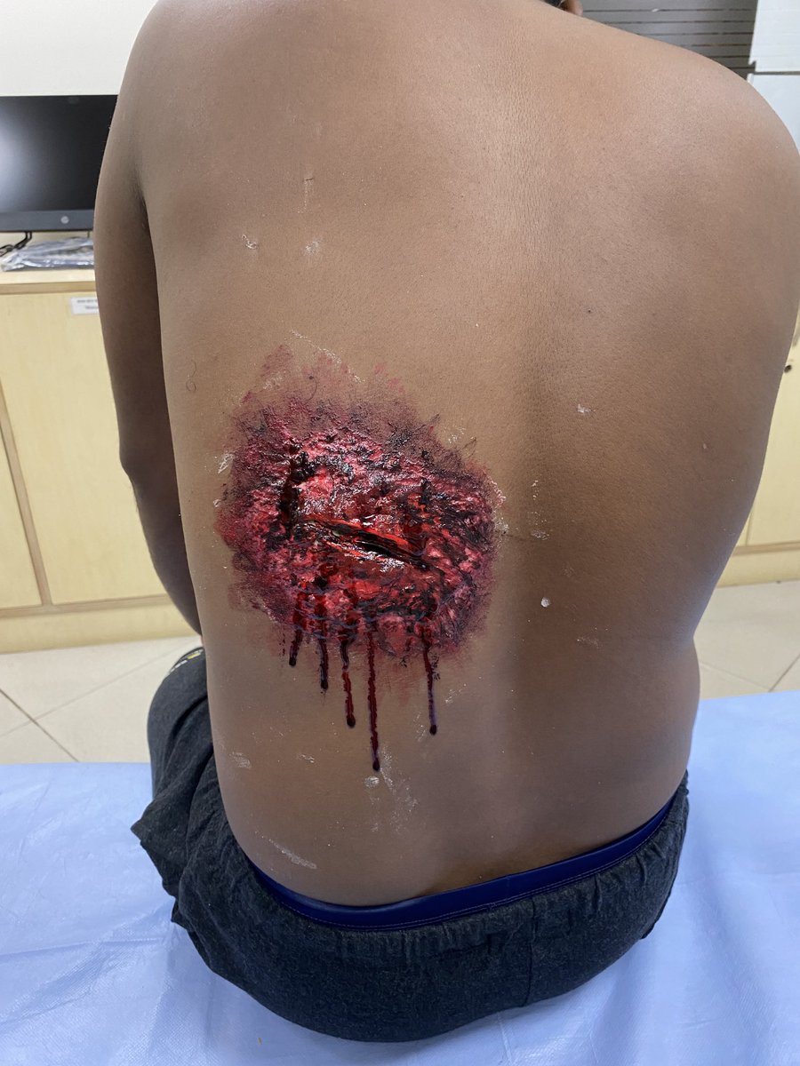 drvimalkrishnan's tweet photo. Moulage is at its best in the ATLS course. Kudos to #ATLSIndia team for encouraging the team to provide the best for the candidates. 
#ATLS ⁦@MAHE_Manipal⁩ ⁦@kmc_manipal⁩ ⁦@MKmcmanipal⁩ 
⁦@acsTrauma #Simulation #MedEd #TraumaEducation #Lifesavers https://t.co/9CGKyUIyBl