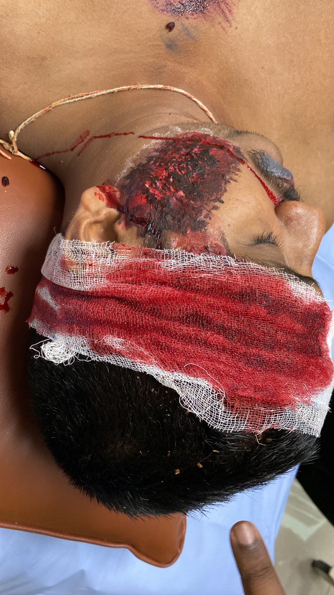 Vimal Krishnan Surendran Pillai (@drvimalkrishnan) on Twitter photo Moulage is at its best in the ATLS course. Kudos to #ATLSIndia team for encouraging the team to provide the best for the candidates.
#ATLS <a href="/MAHE_Manipal/">Manipal Academy of Higher Education</a> <a href="/kmc_manipal/">KMC Manipal</a> <a href="/MKmcmanipal/">MedEdu_KMCManipal</a>
<a href="/acsTrauma/">The ACS Committee on Trauma</a> #Simulation #MedEd #TraumaEducation #Lifesavers Moulage is at its best in the ATLS course. Kudos to #ATLSIndia team for encouraging the team to provide the best for the candidates.
#ATLS <a href="/MAHE_Manipal/">Manipal Academy of Higher Education</a> <a href="/kmc_manipal/">KMC Manipal</a> <a href="/MKmcmanipal/">MedEdu_KMCManipal</a>
<a href="/acsTrauma/">The ACS Committee on Trauma</a> #Simulation #MedEd #TraumaEducation #Lifesavers