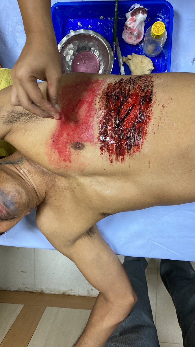 drvimalkrishnan's tweet photo. Moulage is at its best in the ATLS course. Kudos to #ATLSIndia team for encouraging the team to provide the best for the candidates. 
#ATLS ⁦@MAHE_Manipal⁩ ⁦@kmc_manipal⁩ ⁦@MKmcmanipal⁩ 
⁦@acsTrauma #Simulation #MedEd #TraumaEducation #Lifesavers https://t.co/9CGKyUIyBl