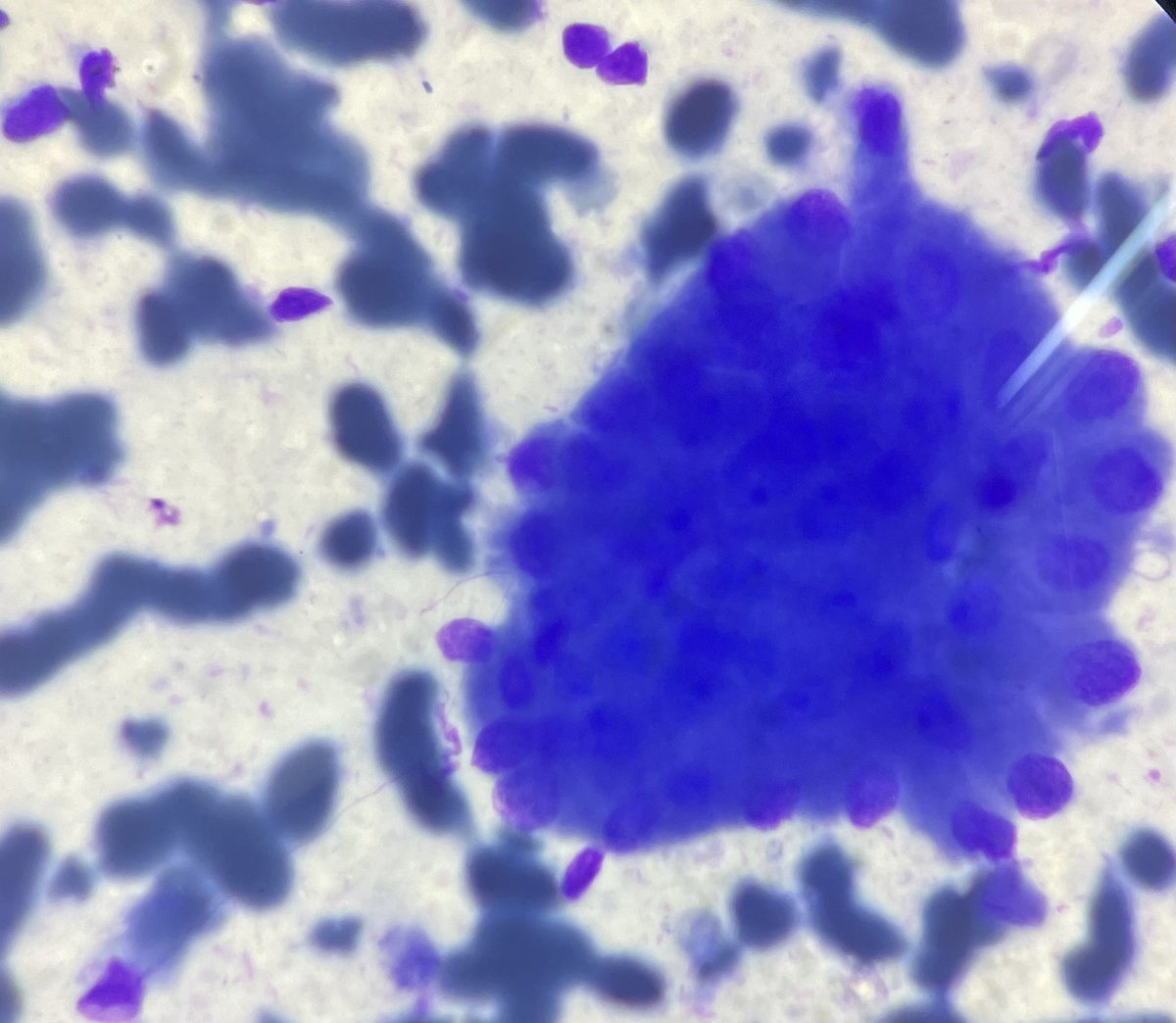 drricha31's tweet photo. #Cytology #cytopath #salivary 

50 year old chronic smoker presented with right submandibular swelling 

On aspiration:-1ml whitish fluid aspirated

Cytology👇
Dirty background 
Lymphocytic infiltrate 
Oncocytic cell clusters https://t.co/wHjN8X2e6o