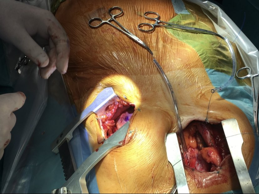 MIC-LVAD-nice approach-easy redo surgery-good outcome#heartfailure#lvad#minimalinvasive#teamsiegburg