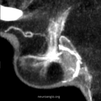 Neuroangio tweet media