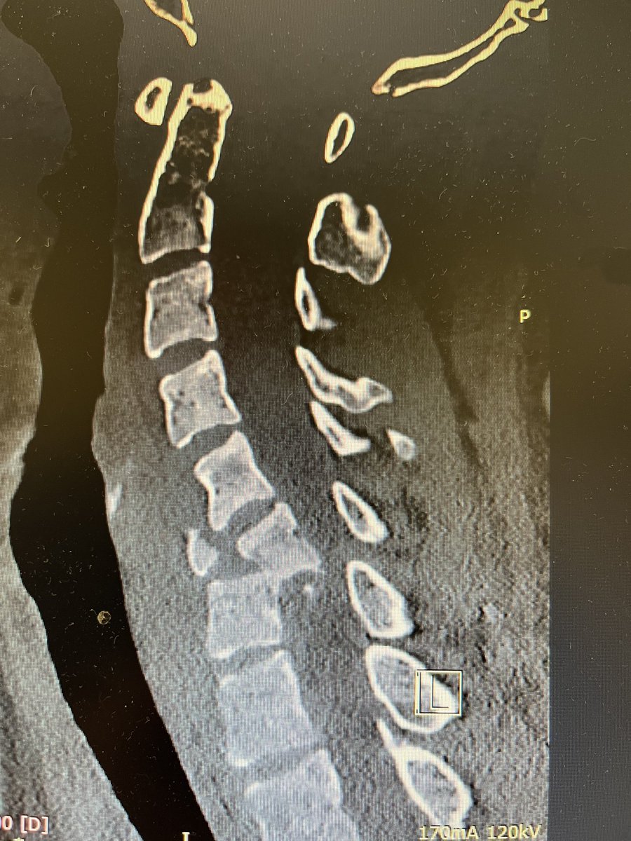 Ludzie nie skaczcie na glowe do wody ..  przed , w trakcie lub po   …. po alkoholu .  Operowalem rano 23y.o. Ofiara imprezy