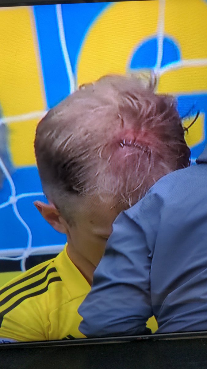 They actually stapled Joe Hart’s cut on his head and he went on to continue playing!!!