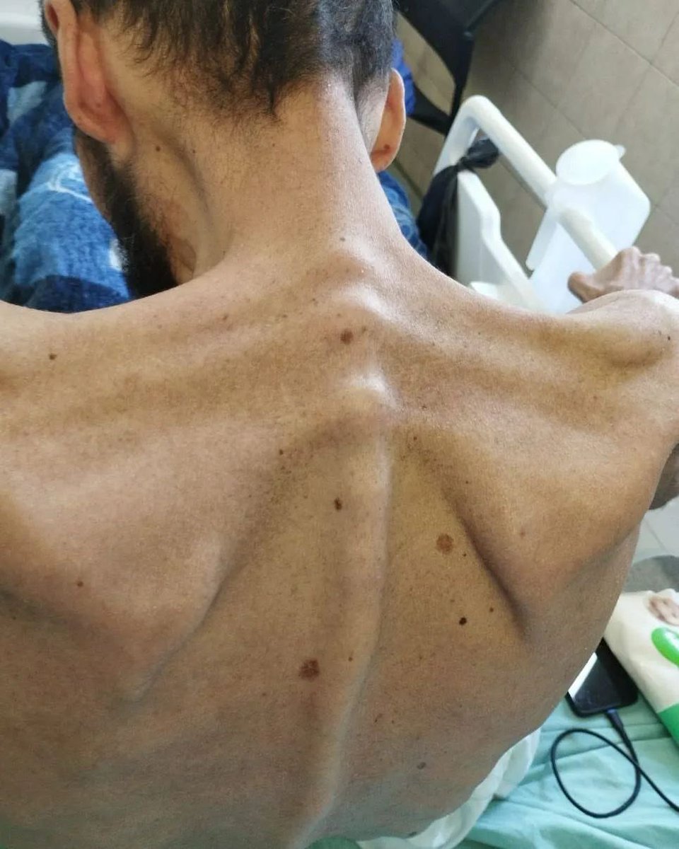MuhammadSmiry's tweet photo. The Palestinian prisoner Khalil Awawdeh after 179 days of hunger strike in protest of his administrative detention without charge or trial by lsrael. https://t.co/UCqe7bvXH3