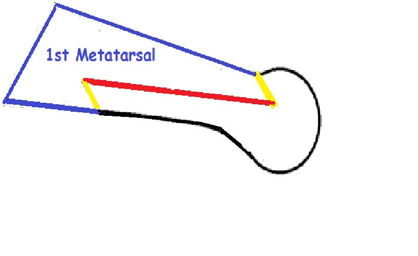 drhiteshg's tweet photo. Which of the following osteotomy has been depicted?
A. Chevron Osteotomy
B. Akin Osteotomy
C. Scarf Osteotomy
D. McBride Osteotomy
#orthotwitter #orthopaedicprinciples #frcsorth #fracs #frcsc #oite #abos #msorth #dnborth https://t.co/suSAvLnLOn