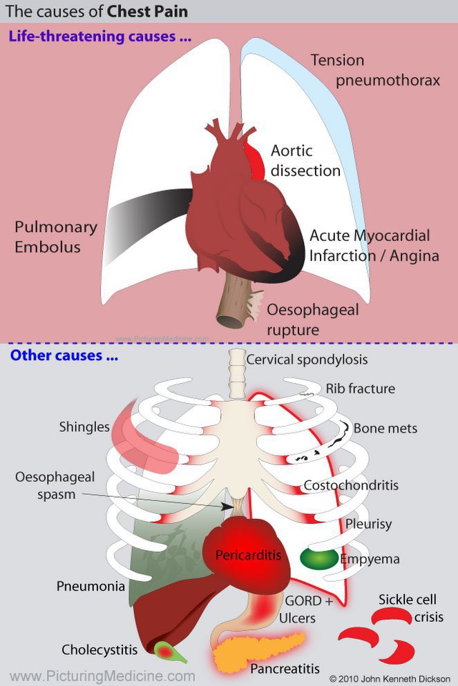 Medical_MD1's tweet photo. Summary Note✨

Differential Diagnosis of Chest Pain😣

. https://t.co/3WoXWT4erb