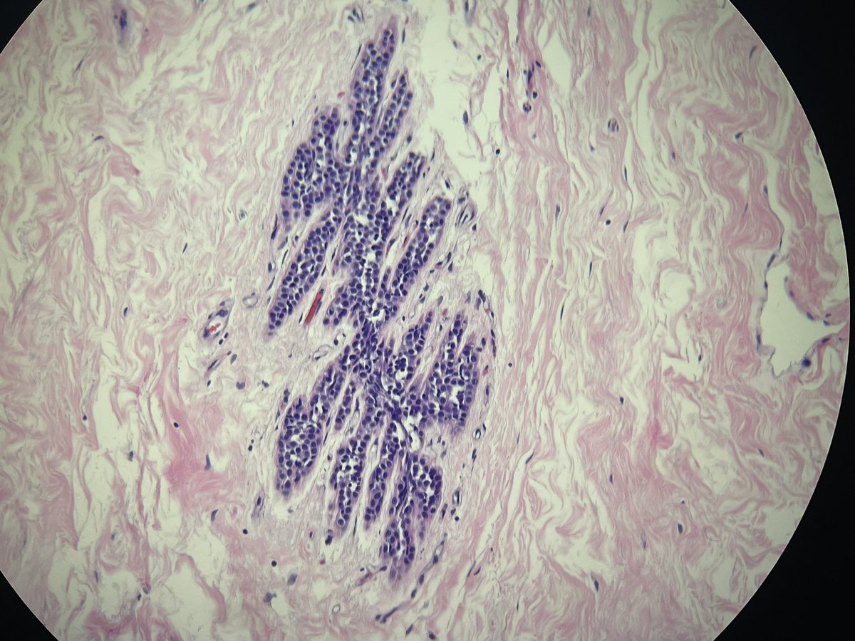Atypical lobular hyperplasia #breast #breastpath