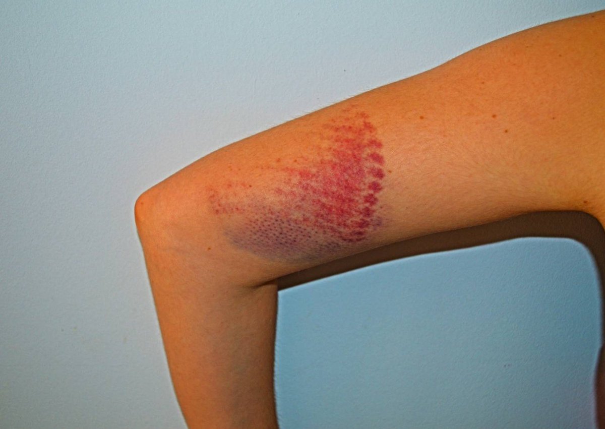 🔴📢 VIOLENCIA POLICIAL / POLIZIAREN-INDARKERIA

La madrugada del sábado, un agente de paisano agredió a una militante de Gazte Komunistak durante el Aste Nagusia en Bilbo.

¿El motivo? Pedirles que se identificaran mientras cometían un abuso de fuerza con un detenido. 

🧵 Hilo: