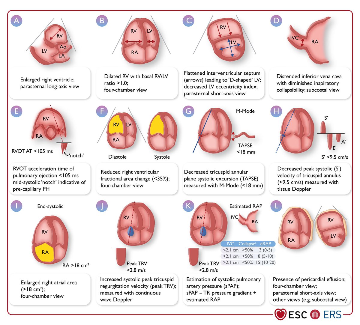 NephroP's tweet photo. Transthoracic echocardiographic parameters in the assessment of pulmonary hypertension.
From the new ESC/ERS guidelines
🔗 https://t.co/dq3bL0mxQm
Click ‘ALT’ for abbreviations 
#echofirst #POCUS #IMPOCUS #MedEd https://t.co/MAchVrhRUs