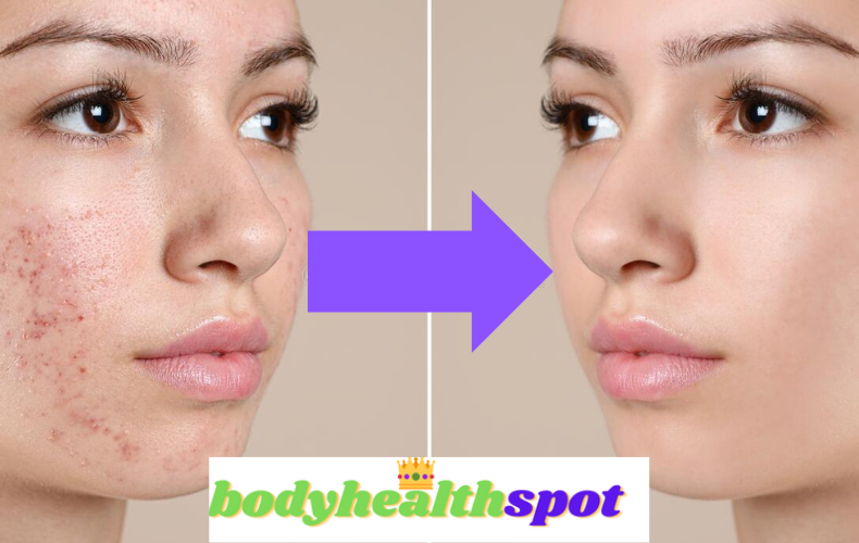 spot_body's tweet photo. Victory over acne: Top 5 main myths about acne: #WritingCommunity #WriteChickens #WriterHelp #WinterChills #SundayLitChats

@lifelovelily22 https://t.co/XJCzLryr1u