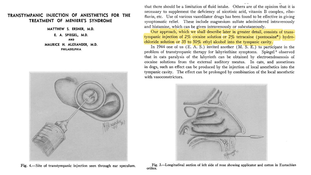 WardensMD's tweet photo. Earliest (1951) transtympanic injections for #Meniere's disease.  Authors felt it had to be done in the OR with a plug in the Eustachian tube to prevent drainage. They injected a mixture of cocaine, tetracaine, and alcohol.  Guaranteed to induce vertigo. #HistoryInMénièresDisease https://t.co/Fqc1fnYaQt