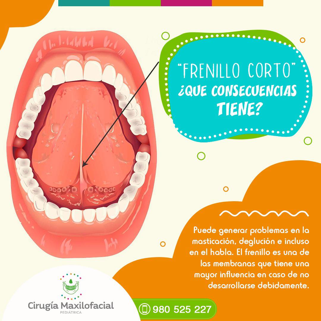 #CIRUGÍA_DE_FRENILLO_LINGUAL_CORTO👅 ✅#CIRUGÍA_BUCAL_Y_MAXILOFACIAL_PEDIATRIC 📲980525227 wa.me/51980525227 📍Calle Mártir Olaya 129, Of 307 #MIRAFLORES. #Bebé #Niños #Frenillolingual #Frenillos #Cirugíamaxilofacialodontopediatria #cirugía #PapisFelices #niñosfelices