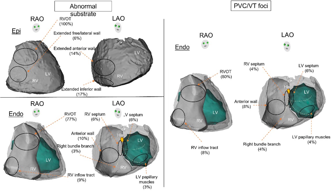 In this systematic review, the substrate for VA in #Brugada wasn’t just localised to the epicardial RVOT! Catheter ablation was safe and efficacious. See our work here: doi.org/10.1007/s00392… #TeamVTWestmead