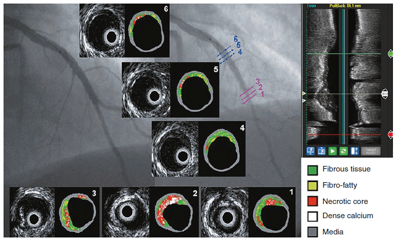 gbiondizoccai's tweet photo. Hybrid Cardiac Imaging for the Invasive Cardiologist, by Romagnoli, Burzotta, Aurigemma and Trani, is the 6th chapter of our book Hybrid Cardiac Imaging for Clinical Decision-Making, by Nudi, Schillaci, Biondi-Zoccai and Iskandrian
https://t.co/kUQIigjlam https://t.co/eYHEG0PmiP