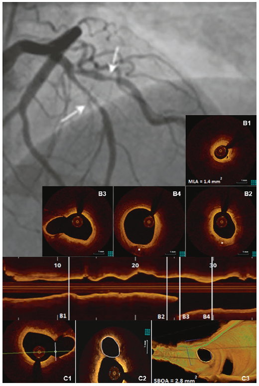 gbiondizoccai's tweet photo. Hybrid Cardiac Imaging for the Invasive Cardiologist, by Romagnoli, Burzotta, Aurigemma and Trani, is the 6th chapter of our book Hybrid Cardiac Imaging for Clinical Decision-Making, by Nudi, Schillaci, Biondi-Zoccai and Iskandrian
https://t.co/kUQIigjlam https://t.co/eYHEG0PmiP