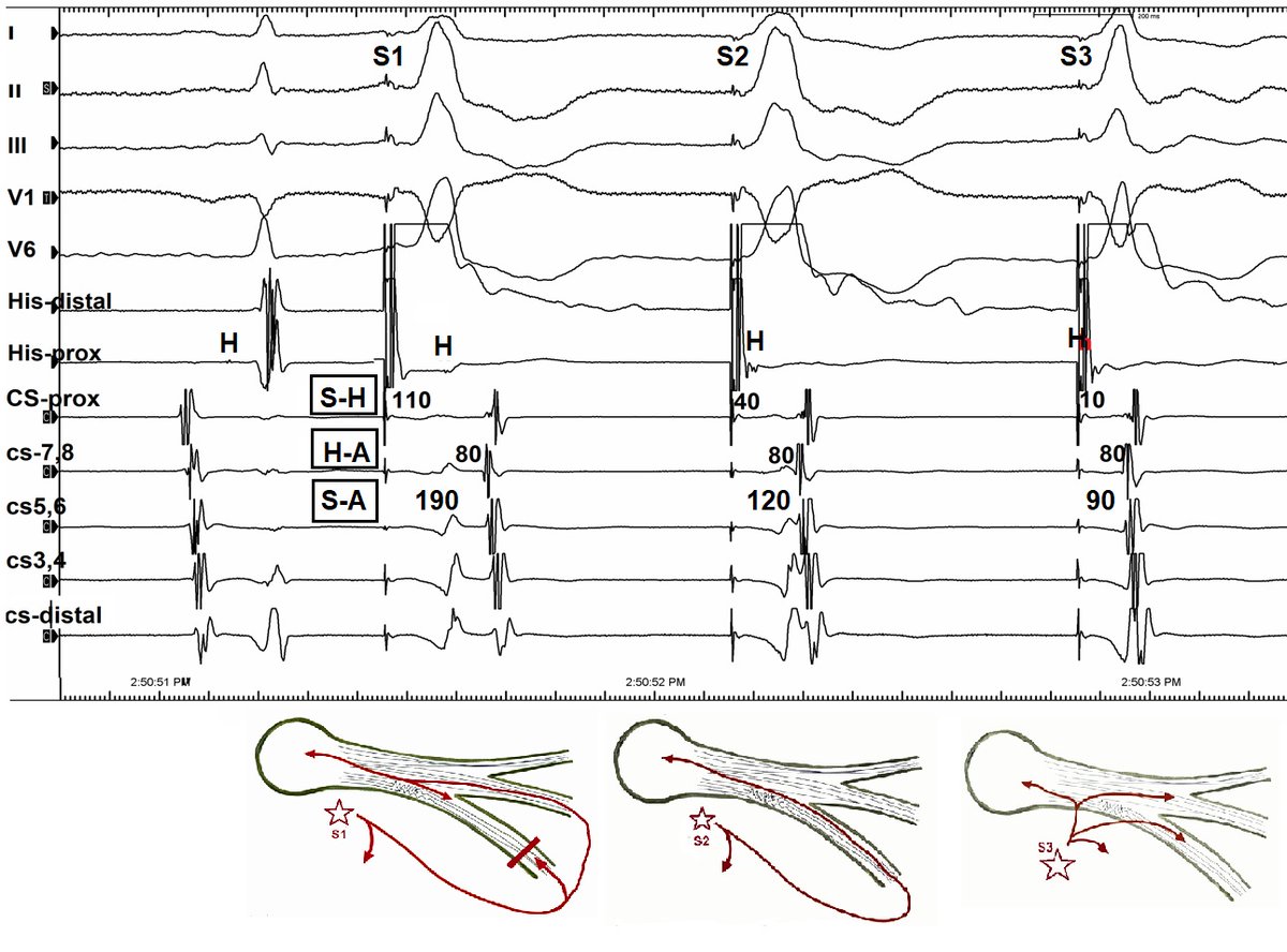 Dual evidence for nodal response to Parahisian PM: retro RBBB and importance of SH interval @Mkara_EP @AhmetKorkmaz07A @ElifhandeMD @drfiratozcan @cardiogenius77 @alsertdemir @prof_serkan_cay @ozcanozeke @DursunAras2 @topaloglu_prof @Hapa_EP @GeorgeKleinMD doi.org/10.1002/joa3.1…