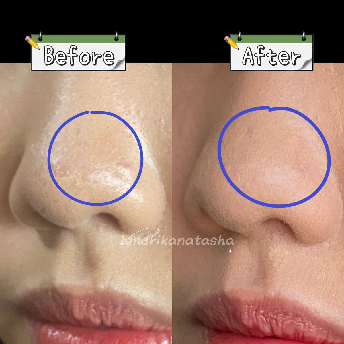 hi__itsnat's tweet photo. ✨How i touch up my makeup✨

Suka sebel gak sih lagi diluar tau-tau makeup kita lonsor bahkan sampai coel kaya di foto ini? 

Nah simak thread ini karena aku mau share tipsnya😊

#⃞⃝tipsbyhindrika #tipsmakeup #racuninmakeup https://t.co/CeWKXAcEwJ