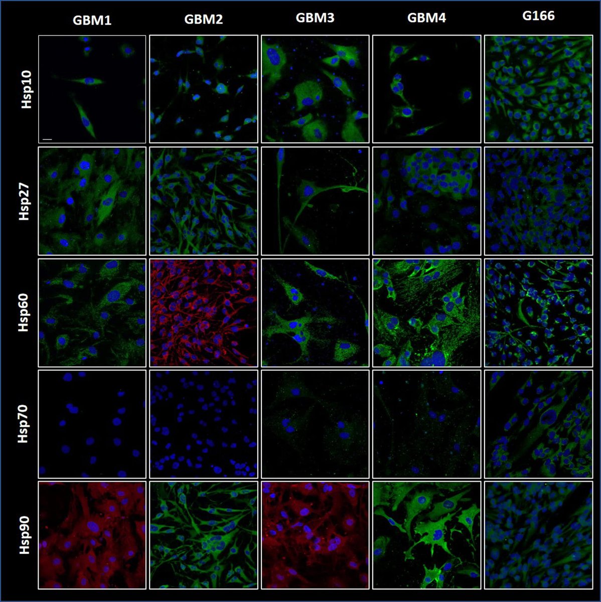 Landmark_IMR's tweet photo. 🌟SELECTED Article🌟
The chaperone system in glioblastoma multiforme and derived cell lines: diagnostic and mechanistic implications
BY: Francesca Rappa from University of Palermo in #Italy
🔍https://t.co/WwWqHWFf0q
#vascular #Glioblastoma #multiforme #Cell https://t.co/7dSAfk2Cuw