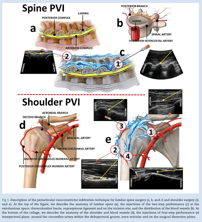 BJAJournals's tweet photo. Periarticular Vasoconstrictor Infiltration(PVI) technique: not just a bloodless field but potential analgesic effects in major orthopaedic surgery. New letter by Escolar et al.

#regionalanaesthesia #haemostasis #orthopaedicsurgery 

https://t.co/mVoHQlRknM https://t.co/hVZfxv5QSZ