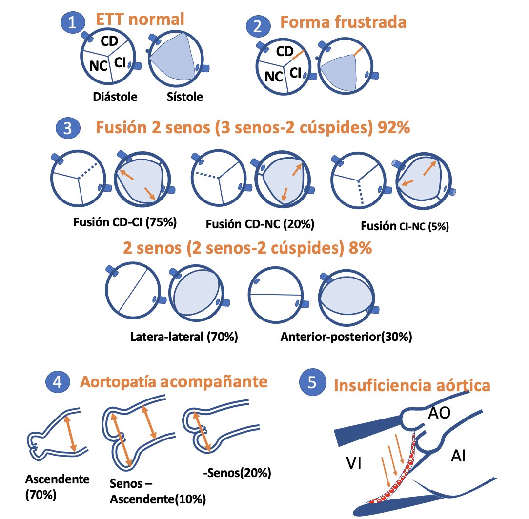 #MáximasEcocardiograficas(10) :
AORTA BICUSPIDE:
1-95% de las AO Bicúspides se diagnostican con ETT.Mirar sístole¡¡
2-Buscar forma frustrada.  
3-Fenotipo más frecuente Fusión CD-CI 
4-Mira la Raiz: aortopatía asociada
5 -IA:Jets muy excéntrico que dificulta cuantificación