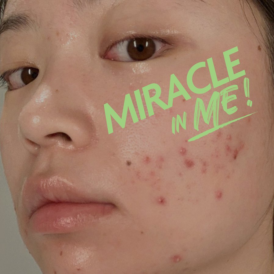 SOMEBYMI_GLOBAL's tweet photo. 💌MIRACLE IN ME MESSAGE
from IG : @roadtorouge @ratughania 

Acne positivity, #Miracle_in_ME 
SOME BY MI with YOU💚

💪Their acne- fight stories,
For more information, see SOME BY MI's Instagram.✨
https://t.co/AQ7XL4S0SI

#somebymi #MiracleInMe #miraclepositive #miracletoner https://t.co/l8GsAlNIXl