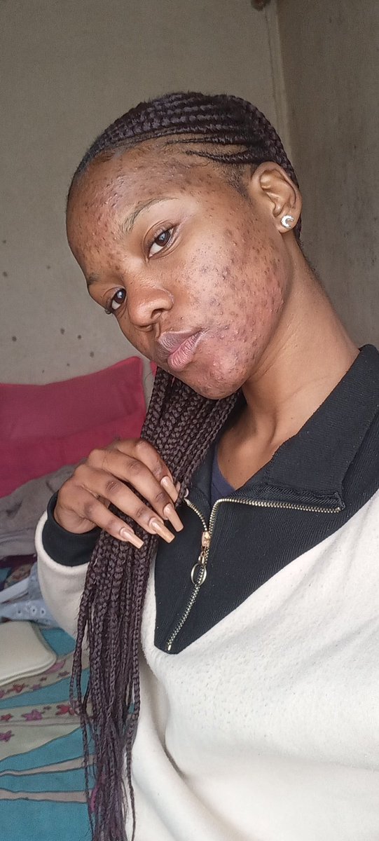 kgosigadi_mo's tweet photo. A little insight of what my life living with acne has been like 🧵🧵 https://t.co/m6vKhjgsw2