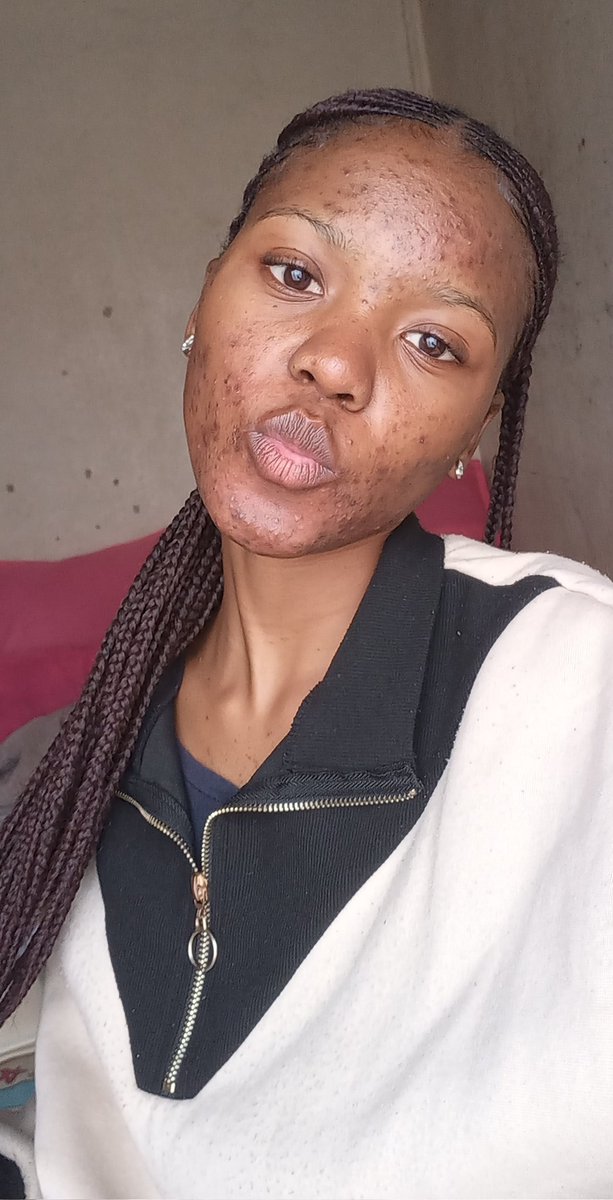kgosigadi_mo's tweet photo. A little insight of what my life living with acne has been like 🧵🧵 https://t.co/m6vKhjgsw2