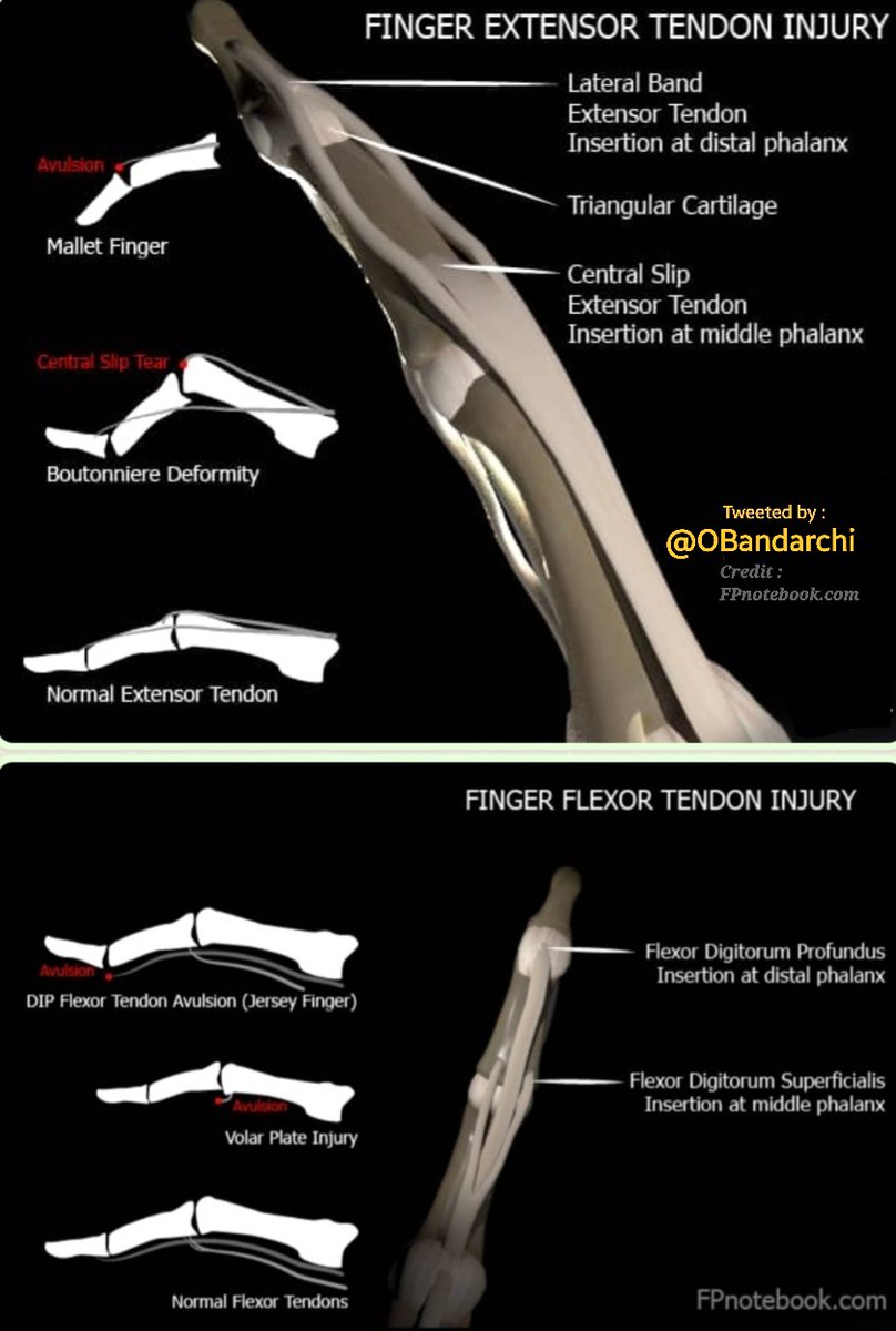 🛑Absolutely wonderful 👍

Finger Extensor Tendon Injury 
                         vs
Finger Flexor Tendon Injury 

#MedTwitter  #radtwitter #musculoskeletal #Orthopaedic
