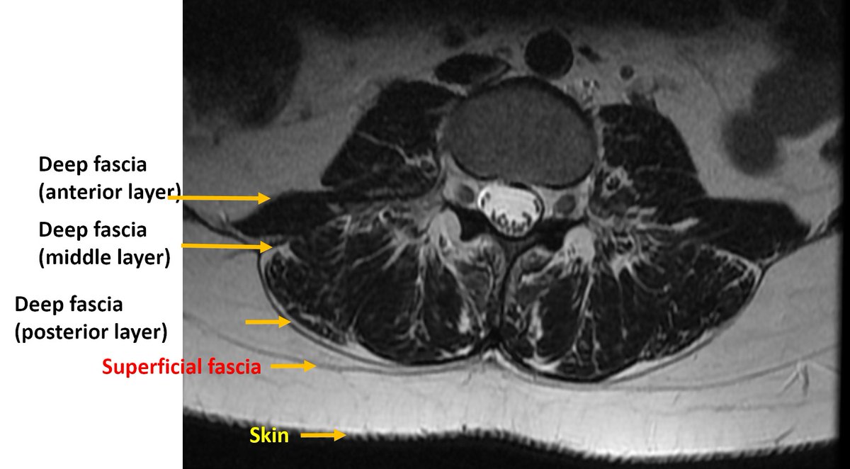 samrad77's tweet photo. Review of fascial anatomy of lumbar perivertebral region. Illustration showing the middle thoracolumbar fascia (MTLF) and its sublayers; the MTLF contains 3 layers/lamina. The circle shows a magnified detailed image of the 3 layers of the MTLF. https://t.co/Z9LfGGfFE0