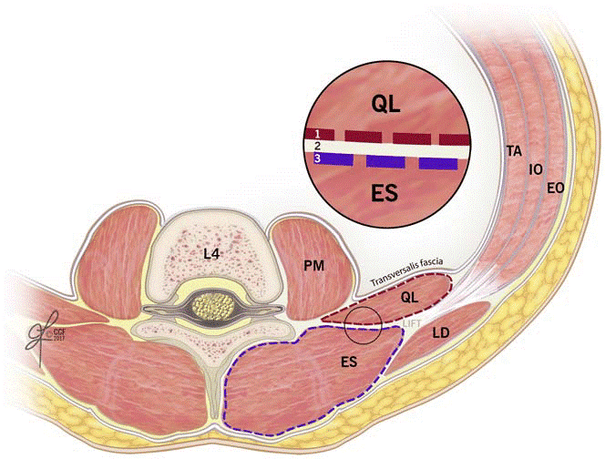 samrad77's tweet photo. Review of fascial anatomy of lumbar perivertebral region. Illustration showing the middle thoracolumbar fascia (MTLF) and its sublayers; the MTLF contains 3 layers/lamina. The circle shows a magnified detailed image of the 3 layers of the MTLF. https://t.co/Z9LfGGfFE0
